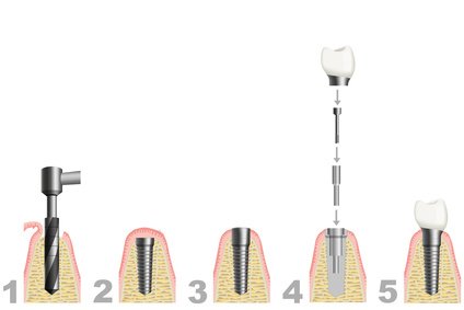 Grafik zur Veranschaulichung des Eingriffs beim Zahnimplantat
